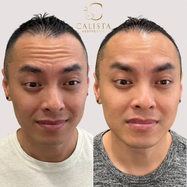 Before and after images of a man showing the results of a forehead treatment. The "before" image highlights visible forehead wrinkles and expression lines, while the "after" image shows a smoother forehead with significantly reduced lines, giving a more youthful and refreshed appearance. Dysport.