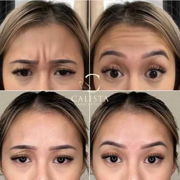 Before and after images of a woman showing the results of a treatment targeting forehead wrinkles and glabellar lines (frown lines between the eyebrows). The "before" images show noticeable frown lines and forehead wrinkles, while the "after" images reveal a smoother forehead with significantly reduced lines and a more relaxed appearance.