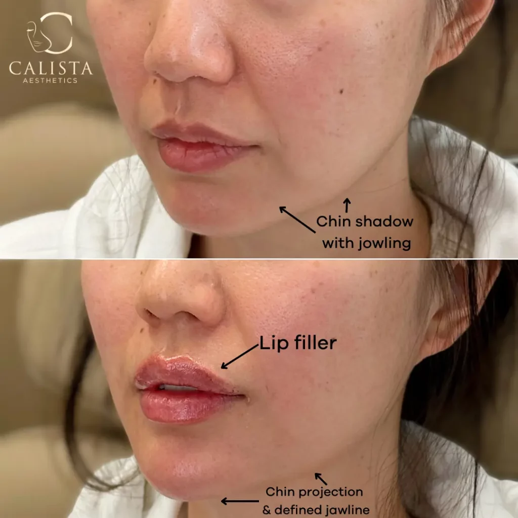 Before and after comparison of a cosmetic procedure showing chin shadow and jowling in the "before" image, and enhanced chin projection, defined jawline, and lip filler in the "after" image. The images are labeled to highlight the improvements post-treatment.