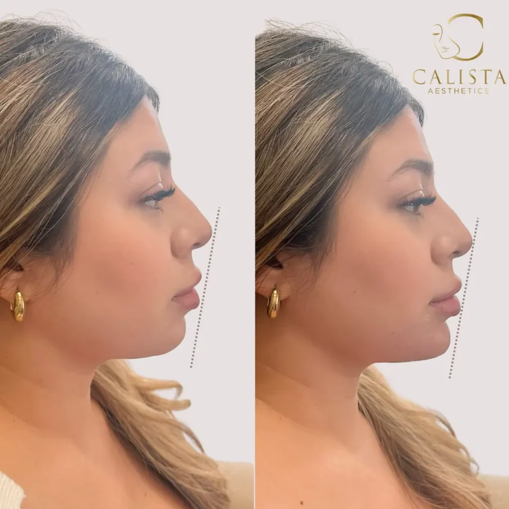 Side-by-side before and after images of a woman showcasing the results of chin enhancement, with noticeable improvements in chin projection. Both images are aligned with a dotted vertical line to emphasize the change in facial profile. The "after" image reflects a more defined and balanced profile. Nose filler, lip filler, chin filler.