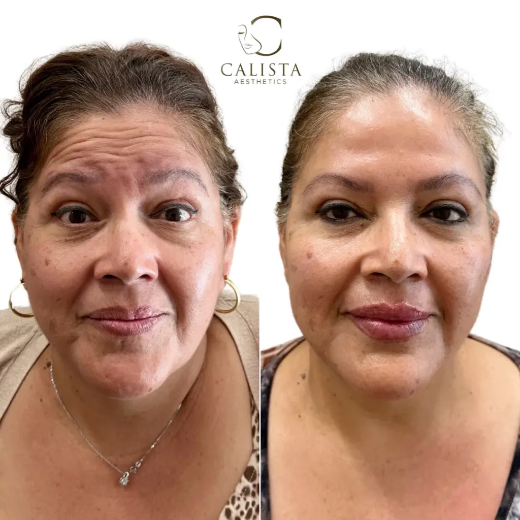 Before and after images of a middle-aged woman showing the results of a facial aesthetic treatment. The "before" image highlights deeper wrinkles and lines, particularly on the forehead and around the mouth. The "after" image shows smoother skin with reduced wrinkles, giving a more refreshed and youthful appearance. Cheek filler, chin shadow, anti-wrinkle treatment for upper and lower face.