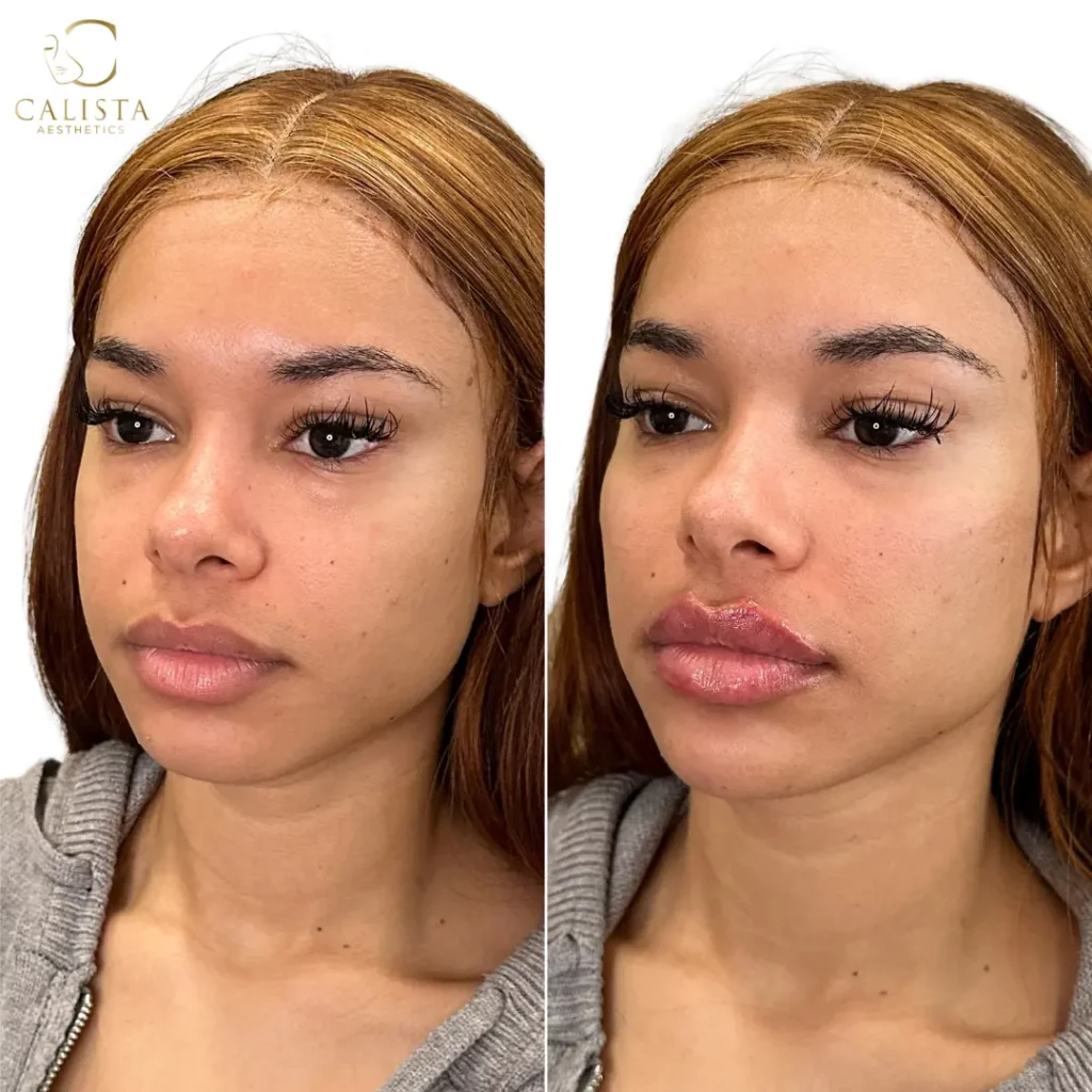 Before and after images of a woman showing the results of a lip enhancement procedure. The "before" image shows the woman's natural lips, while the "after" image highlights fuller, plumper lips with a glossy finish. The procedure enhances the volume and definition of the lips. Lip filler, cheek filler, chin filler.