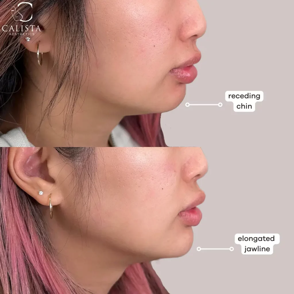 Before and after comparison of a woman showing the results of a chin enhancement procedure. The "before" image highlights a receding chin, while the "after" image shows an elongated jawline with a more defined chin and improved facial contour. Chin filler.