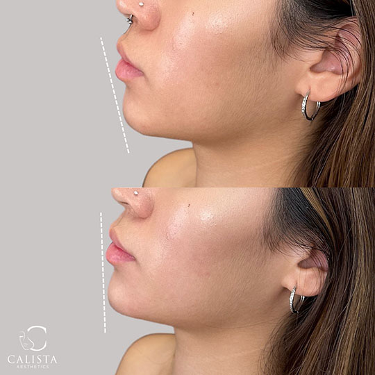 Before and after profile views of a woman's chin and lips. The top image shows a less pronounced chin and lips, while the bottom image displays a more defined chin and fuller lips post-treatment. Chin filler.