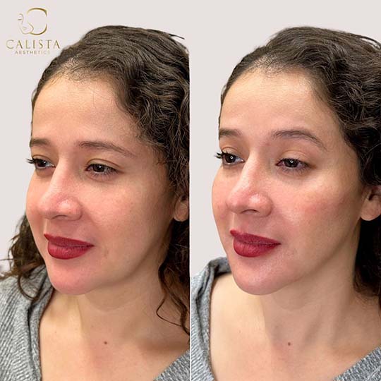 Before and after aesthetic procedure of a woman with a light skin tone, showing natural lip enhancement and a more radiant facial appearance from Calista Aesthetics. Cheek filler, chin filler, chin shadow.