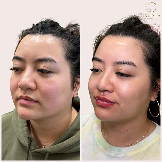 Before and after results of facial aesthetic treatment on an individual with medium skin tone, showcasing enhanced lip volume and subtle chin contouring improvements at Calista Aesthetics.