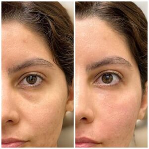 Before-and-after comparison of an aesthetic treatment focused on the area beneath the eyes. On the left side of the image, the person has noticeable dark circles and some hollowness under the eyes, while on the right side, after the treatment, the under-eye area appears smoother, brighter, and more even, with reduced hollowness and discoloration. The individual's skin tone looks more radiant, and there is an overall refreshed appearance to the face. Under eye treatment.