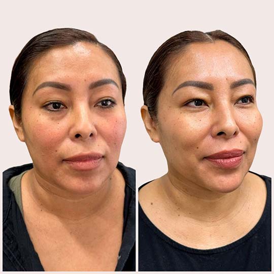 Before and after image of a woman at Calista Aesthetics. The left side shows her natural face before treatment, and the right side shows her face after treatment with more defined features and slightly fuller lips. PRF EZ Gel, chin filler, chin shadow.