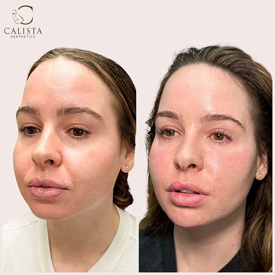 Before and after image of a woman at Calista Aesthetics. The left side shows her appearance prior to treatment, while the right side shows enhanced lip volume and smoothness after the procedure. PRF EZ Gel, tox, chin filler, chin shadow.