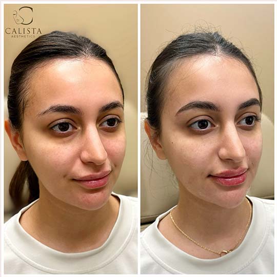 Before and after image of a young woman at Calista Aesthetics. The left side shows her natural facial appearance before treatment, while the right side shows subtle improvements in lip volume and facial symmetry after the treatment. Smile line treatment, chin filler, chin shadow, lip filler, PRF EZ Gel.