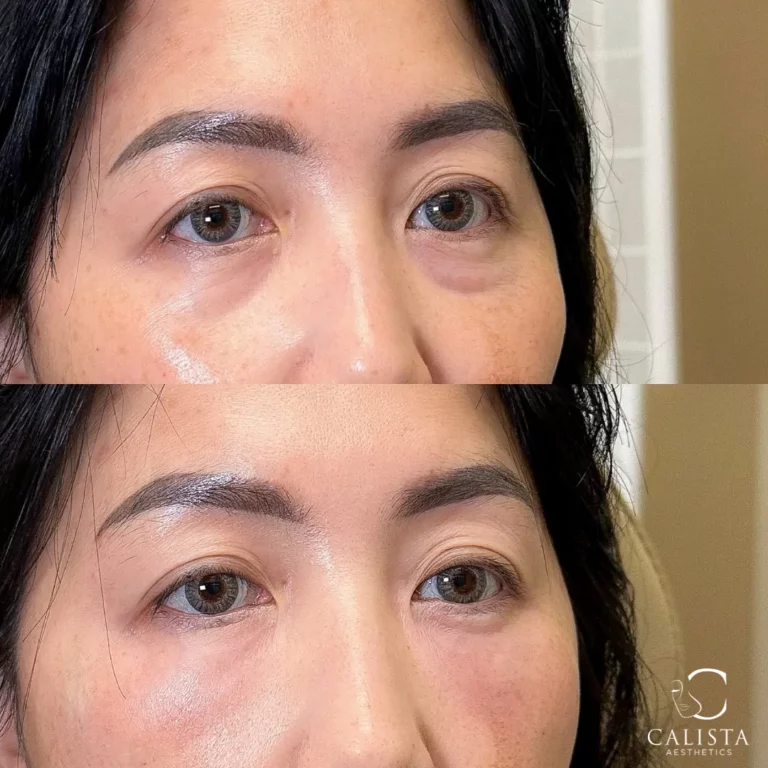 Close-up before-and-after image of a woman's under-eye area showing reduced puffiness and smoother skin after a treatment. Under eye treatment, prf ez gel