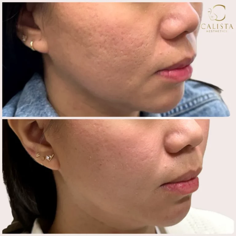 Before and after comparison of a woman's cheek area showing skin texture improvement from microneedling treatment at Calista Aesthetics, with reduced acne scars and smoother skin in the after image. SkinPen.