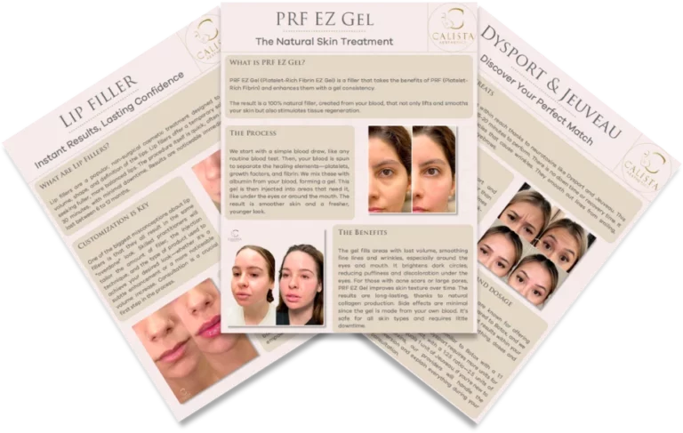 Three informative brochures from Calista Aesthetics highlighting cosmetic treatments: "Lip Filler" explaining customization for natural, lasting results; "PRF EZ Gel" detailing a skin treatment for rejuvenation and tissue regeneration using platelet-rich fibrin; and "Dysport & Jeuveau" focusing on injectable treatments for wrinkle reduction and skin smoothing.